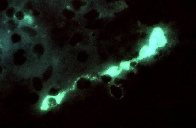 Schizofrenia sotto controllo in quattro mosse