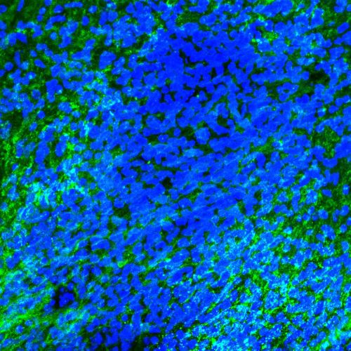 Sclerosi multipla: nuovi studi sul ruolo della microglia