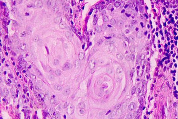 Tumore al polmone: scoperte nuove cellule immunitarie