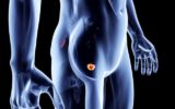 Tumore alla prostata: nuovi dati