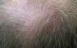 alopecia areata stress
