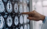 Tumori: glioma, Fda riconosce come farmaco orfano l'isotopo rame-64 sviluppato nelle Marche