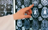 Perché la riabilitazione post-ictus è più difficile per le donne? Perché la riabilitazione post-ictus è più difficile per le donne?