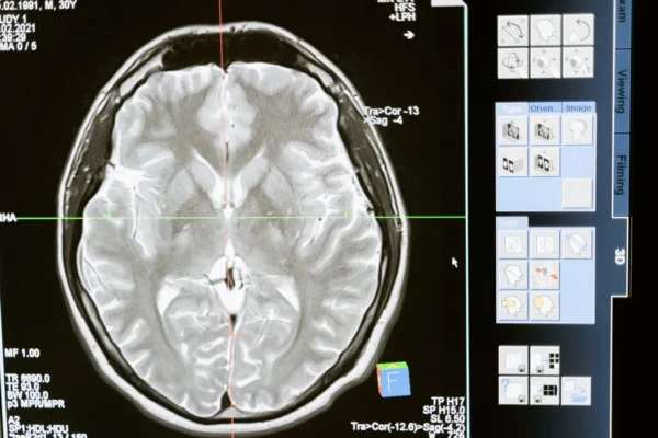 L’ictus può favorire la comparsa di tumori cerebrali