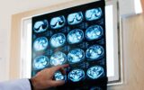 Nodulo polmonare: che cos’è, come si diagnostica e quando intervenire Nodulo polmonare: che cos’è, come si diagnostica e quando intervenire